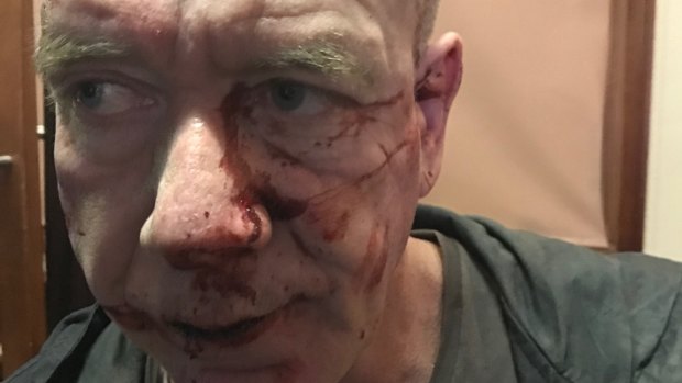 Tony was viciously assaulted at a pub in Melbourne last August.