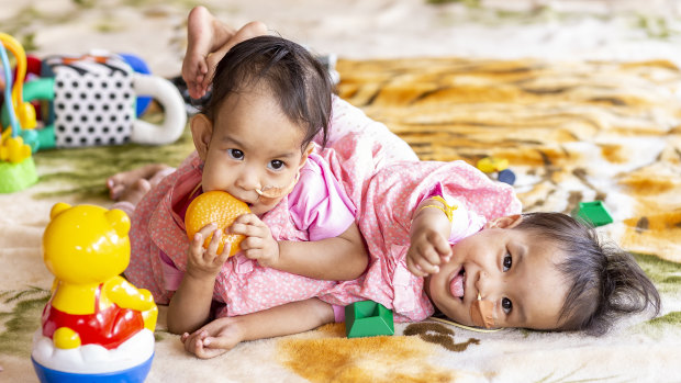 Conjoined twins Nima and Dawa before their surgery.