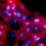 A culture of human breast cancer cells.