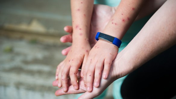 Samara Zeitsch holds her daughter's hands showing the large number of wasp stings she received from the attack.
