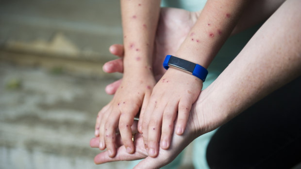 Samara Zeitsch holds her daughter's hands showing the large number of wasp stings she received from the attack.