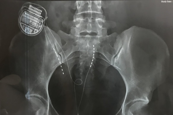 An x-ray showing Lauren Iacobucci’s spinal cord stimulator in situ.