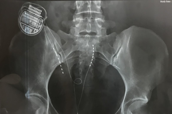 An X-ray showing a spinal cord stimulator in situ.