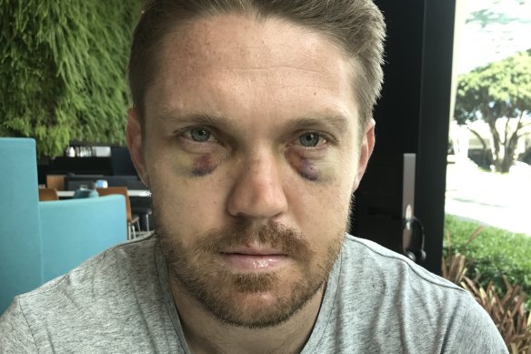 Friendly fire: Chris Lawrence after his training mishap at the start of 2019.