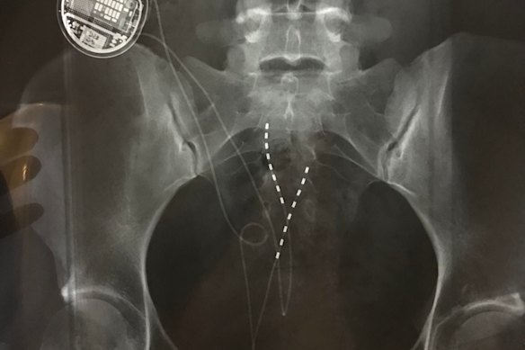 An X-ray showing a spinal cord stimulator implanted in a patient.