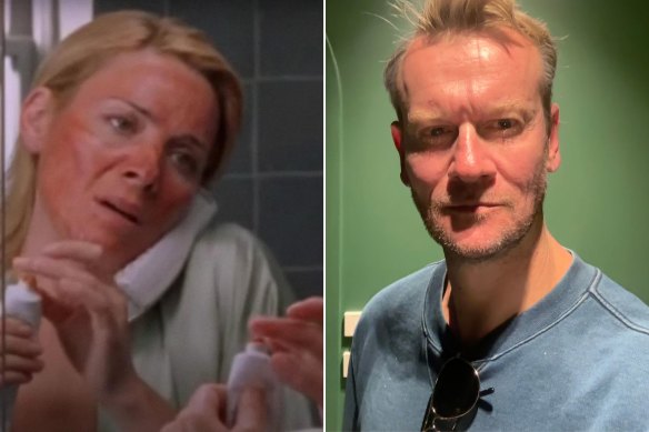Actor Kim Cattrall as Samantha Jones who receives a damaging chemical peel in a 2002 episode of Sex and the City; journalist Damien Woolnough, 50, immediately after receiving a skin needling treatment.