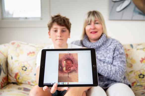 Gus Charles and his mother Sally.  Gus was diagnosed with a Buruli ulcer in 2017. 