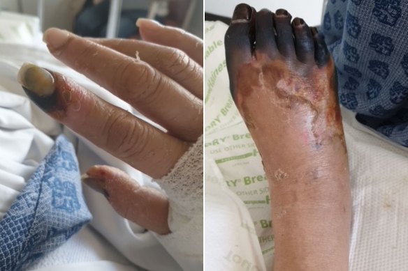 Life-saving drugs caused necrosis of her hands and feet.