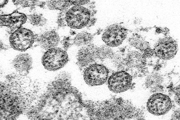 An image of coronavirus particles from what was believed to be the first US case of COVID-19. 
