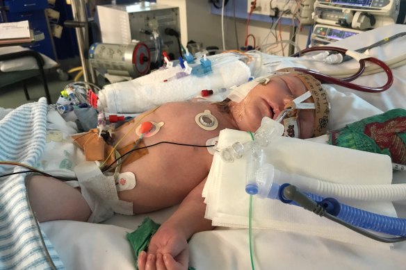 A baby hooked up to an ECMO machine at Sydney Children’s Hospital.