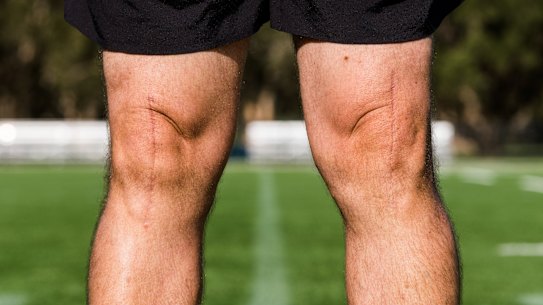 Mitsios’s knees, showing the scars from a double knee replacement.