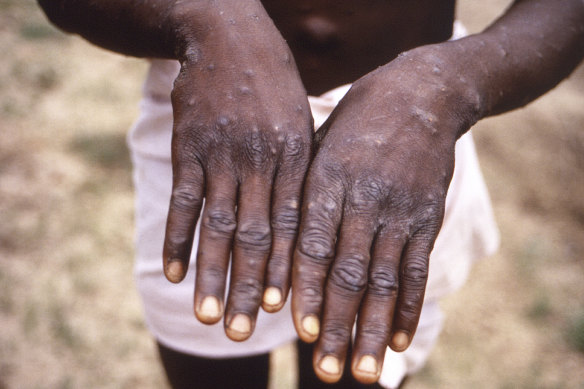 Monkeypox causes a rash during its recuperative stage.
