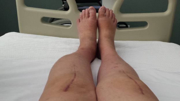 Kim Gollan’s leg grew a lump following a double knee replacement with Al Muderis in 2016.