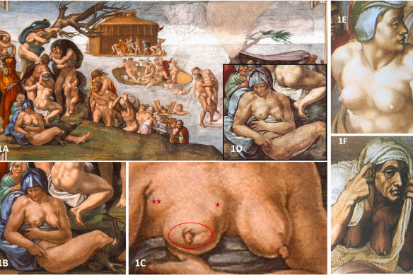 A close up of the right breast of the woman in the blue headscarf shows nipple retraction and fissural defects of the upper and medial areola (1C). The one and two stars show two bulging lumps. On the right, the healthy breasts of a young (top) and an older woman (bottom). 1D is a pre-restoration photo.