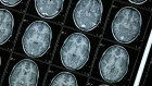 Actinogen is led by the former chief medical officer of Principia Biopharma, which was acquired by Sanofi for $US3.68 billion in 2020.
