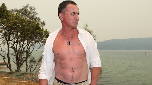 Shannon Noll, and the scar from his operation.