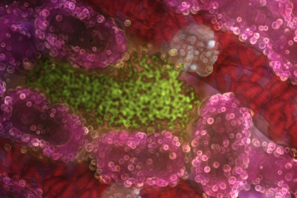 Illustration of liver cells (pink) infected with a malaria parasite (green).