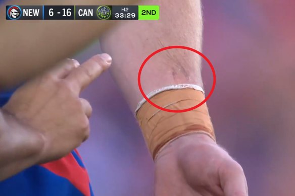 Tyson Gamble’s forearm after the alleged bite.