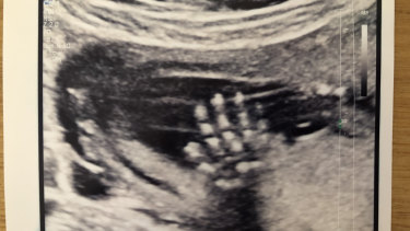 An ultrasound photo of Elizabeth Callinan's daughter Greta "waving".  