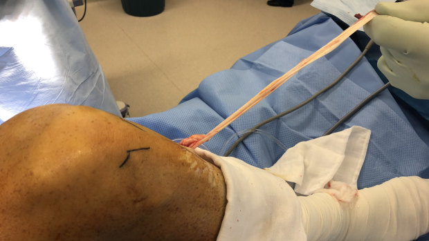 Dr Hartnell says human hamstring tendon (shown here in knee reconstruction surgery)   is remarkably similar to a kangaroo's, although a roo tendon is as much as six times stronger.