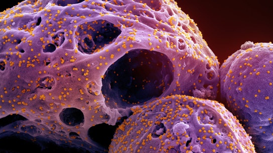 This colourised electron microscope image made available by the National Institute of Allergy and Infectious Diseases shows cells, indicated in purple, infected with COVID-19.