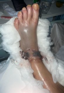 Glenn Maxwell’s left foot immediately after surgery.