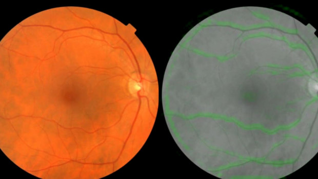 A scan of the back of the human eye (left), and how Google's algorithm sees it. The green highlights are the parts the algorithm found most helpful in predicting blood pressure. 