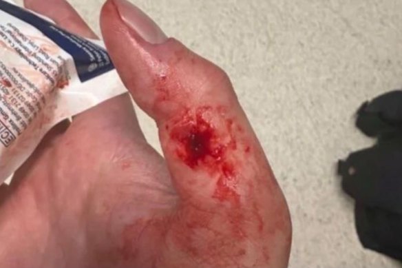 A NSW Police officer’s bloody hand after being allegedly bitten by a protester.
