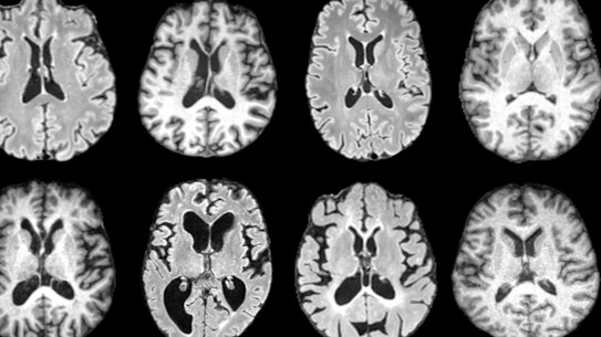 MRI brain scans showing 10 different dementia types.