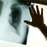 New taskforce will tackle growing lung disease crisis, government vows