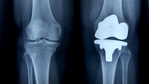 GPs have been issued new guidance on treating knee pain.
