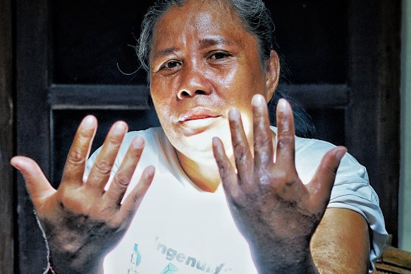 Tumini showing some of her scars from the Bali bombing. Her wounds were so ghastly that hospital staff assumed she was dead.