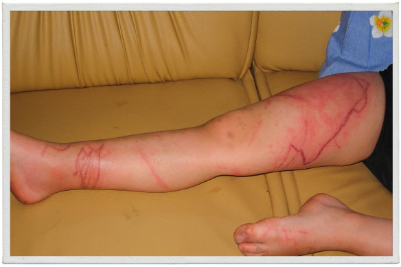 The welts on Lewis Jones' legs after he was stung by a box jellyfish.