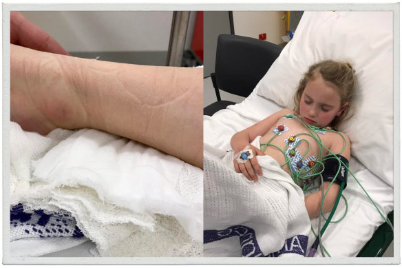 The area of the bite on Poppy's ankle; Poppy was in hospital for four days.