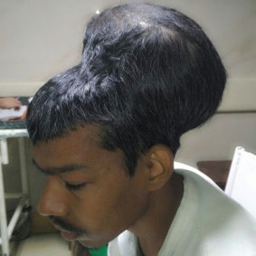 Doctors in India who have removed a 1.8kg brain tumour from a 31-year-old man say it could be the largest in the world.