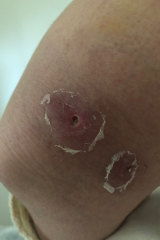 A previous Buruli ulcer case in a Seddon resident.