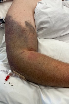 Extensive bruising on Luke Briggs’ arm after his arrest.