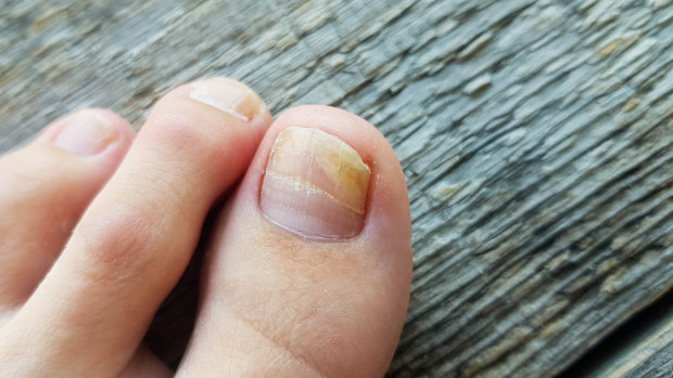 The dodgy nail salon practices fuelling a surge in fungal infections