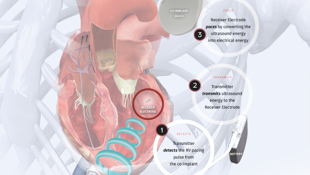 How the EBR Systems’ WISE technology works in the heart. 