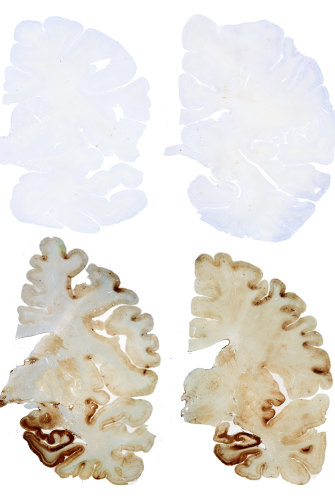 The top two brain cross-sections are a healthy "control" brain while the sections below show a brain with CTE. 