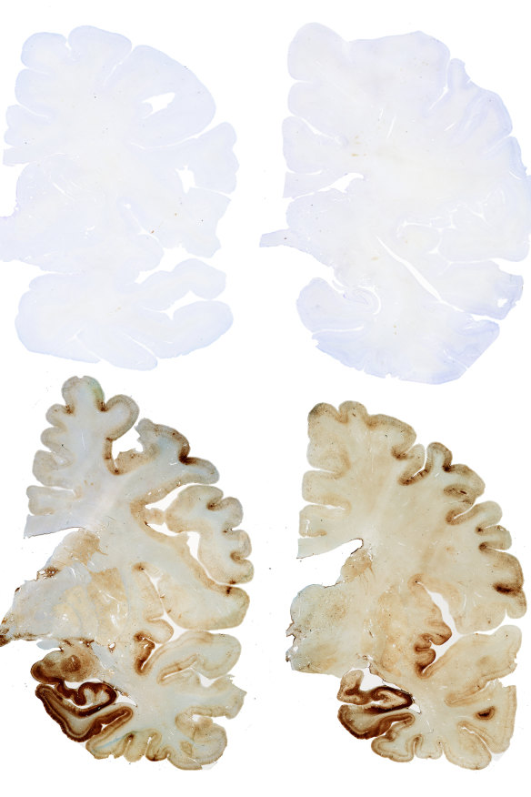 The top two brain cross-sections (stained in colour) are a healthy “control” brain while below shows CTE in a brain section.  