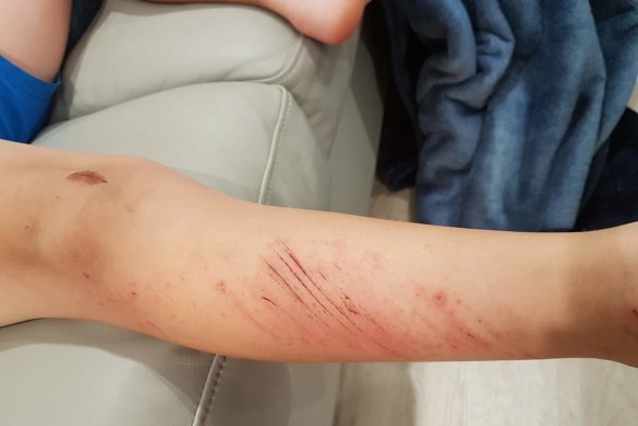 Images of a child's injuries in an incident raised with the directorate in March 2018.