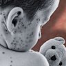 NSW Health is encouraging the public to check their immunisation records due to measles outbreaks.