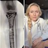 Lindsey Vonn opens up on the extent of her injuries.