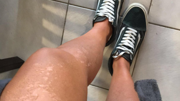 Georgia Gordon's skin peels after severe sunburn on her legs.