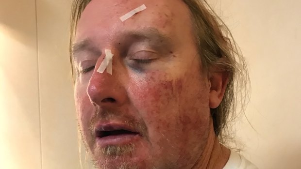 Sydney man Anthony Titow, 45, suffered facial injuries in a cruise ship brawl allegedly sparked by inappropriate comments directed towards a female relative. 