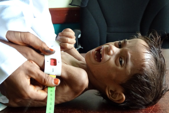Ahmed Abdo Salem, a two-year-old Yemeni displaced by the conflict and weighing only five kilograms is measured at a health clinic in Yemen’s war-ravaged western Hodeida province last month.