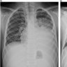 Collection of radiographs show the effects of mycoplasma pneumoniae on the lungs of children. Source: Cho et al (2019)