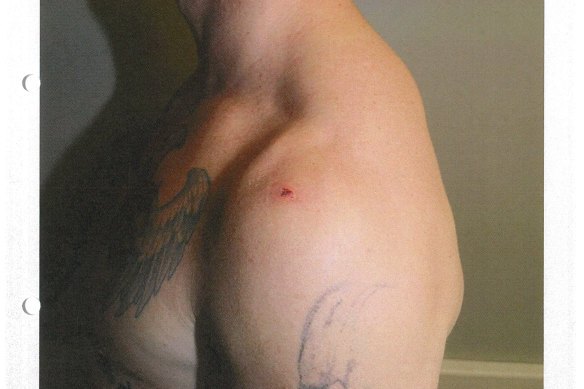The shoulder injury sustained by Constable Zachary Rolfe when he was stabbed by Kumanjayi Walker.