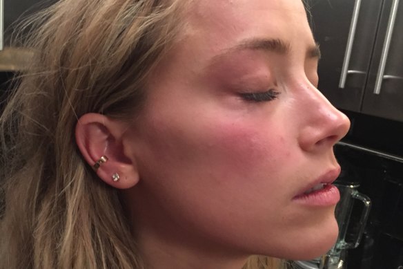 This handout photo provided by London High Court shows a photo used in evidence of Amber Heard with marks on her face that she says were inflicted by Johnny Depp in May 2016.